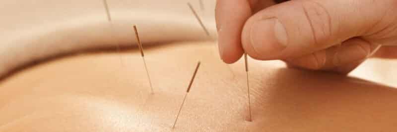 acupuntura dor ciatica lisboa