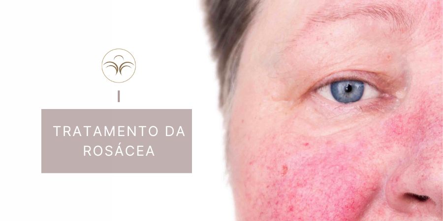 Tratamento-Rosacea-Couperose-Vermelhidao-lisboa