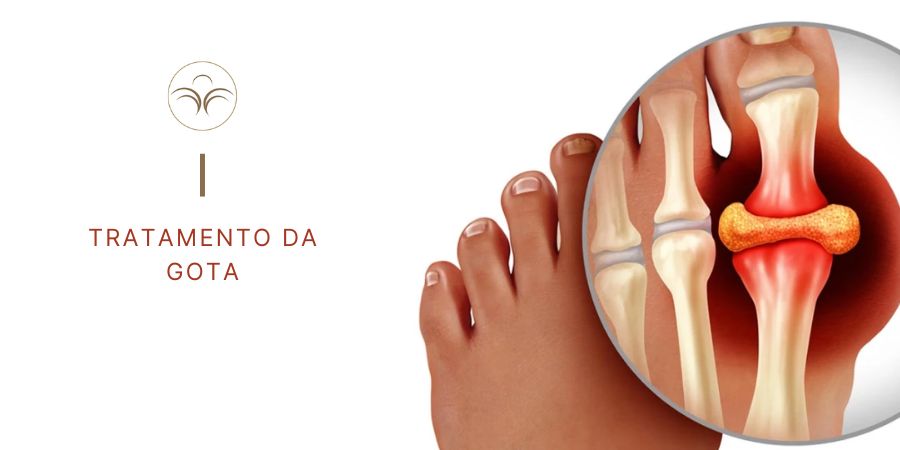 Tratamento-Gota-Lisboa