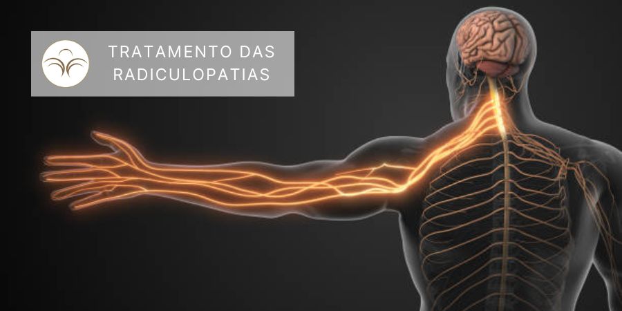 Tratamento-Radiculopatias-Lisboa