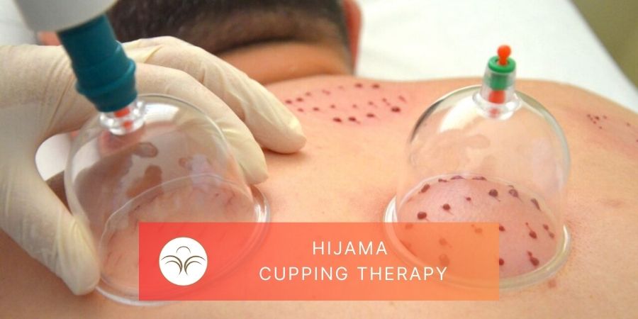 Hijama Cupping Therapy em Lisboa